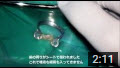 東京都でラバーダム防湿を使って歯の根の治療をする歯医者（歯科）