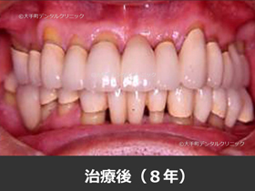 重度歯周病例の治療後の画像