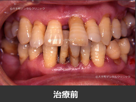 重度歯周病例の治療前の画像