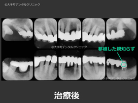 東京の歯周病治療の名医が治療した重度歯周病患者の治療後のレントゲン