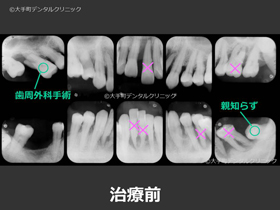 東京の歯周病治療の名医が治療した重度歯周病患者の治療前のレントゲン