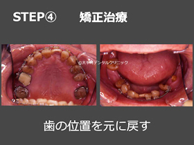東京の矯正の名医が重度歯周病患者の矯正治療行った後の画像