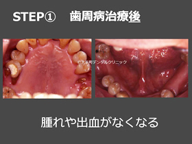 東京でおすすめのスウェーデン式歯周病治療の治療後の画像