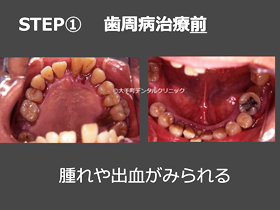東京でおすすめのスウェーデン式歯周病治療の治療前の画像