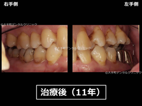 重度歯周病ケース２治療後１１年