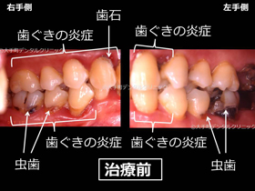 重度歯周病ケース２治療前