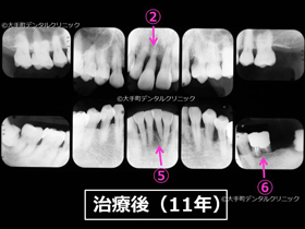重度歯周病ケース２治療後１１年のレントゲン