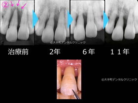 重度歯周病ケース２治療後の経過のレントゲン上の前歯