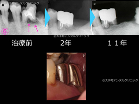 重度歯周病ケース２治療後の経過のレントゲン左下奥歯