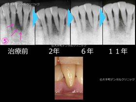 重度歯周病ケース２治療後の経過のレントゲン下の前歯