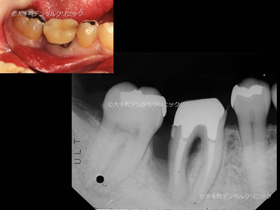 東京の名医の行った歯槽骨再生手術前のレントゲン