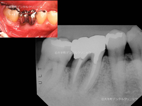 東京の名医が行った歯槽骨再生手術後１１年のレントゲン