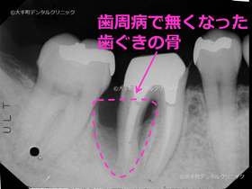 歯槽骨再生手術前