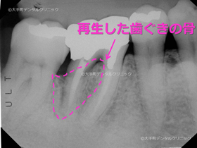 歯槽骨再生手術後11年