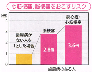 歯周病と心筋梗塞、脳梗塞、狭心症の関係、東京都千代田区の歯科、歯医者（7）