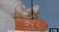歯周病の検査方法の解説動画