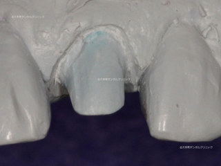 エポキシ樹脂で制作した歯科模型