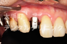 前歯インプラントの例（治療中）
