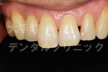 前歯インプラントの例（治療後）