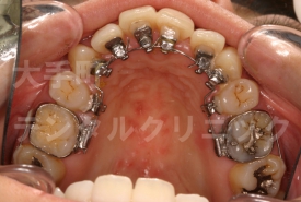 審美歯科、舌側矯正（上）