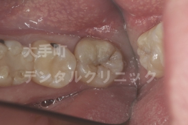 審美歯科、虫歯の治療（術後）