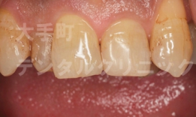 審美歯科、前歯の治療、術後