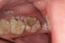 審美歯科、虫歯の治療（術前）
