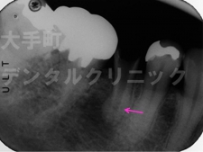 東京都千代田区大手町の歯科、根の治療（臼歯）ファイル除去後