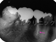 東京都千代田区大手町の歯科、根の治療（臼歯）ファイル除去前