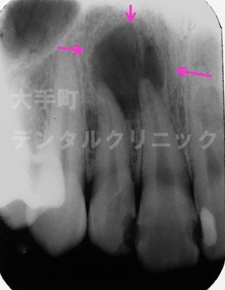 東京都千代田区大手町の歯科、根の治療（前歯）治療前１