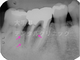 歯周病の治し方、再生治療（術前）