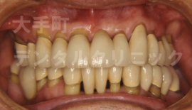 歯周病の治し方、難しい例（治療後）