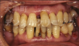 歯周病の治し方、難しい例（治療前）