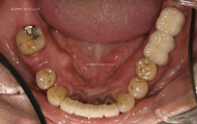東京のインプラント専門医の治療例下顎（治療前）