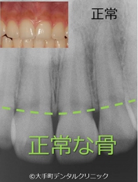 正常な歯ぐきの骨の写真