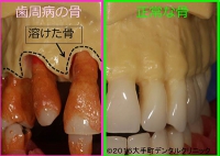 歯周病の骨と健康な骨の違いと症状