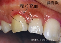 歯肉炎の写真と症状