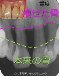 歯周病重度の写真とレントゲンと症状